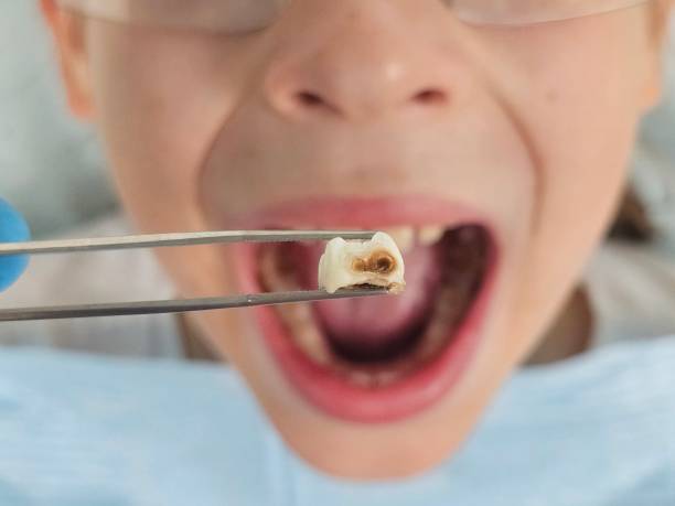 Best Emergency Tooth Extraction in Black River, NY